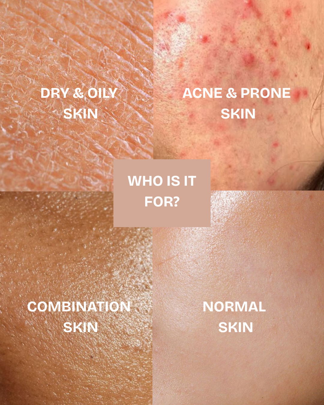 Acne & Scar Treatment Serum | All Skin Type - 30ml