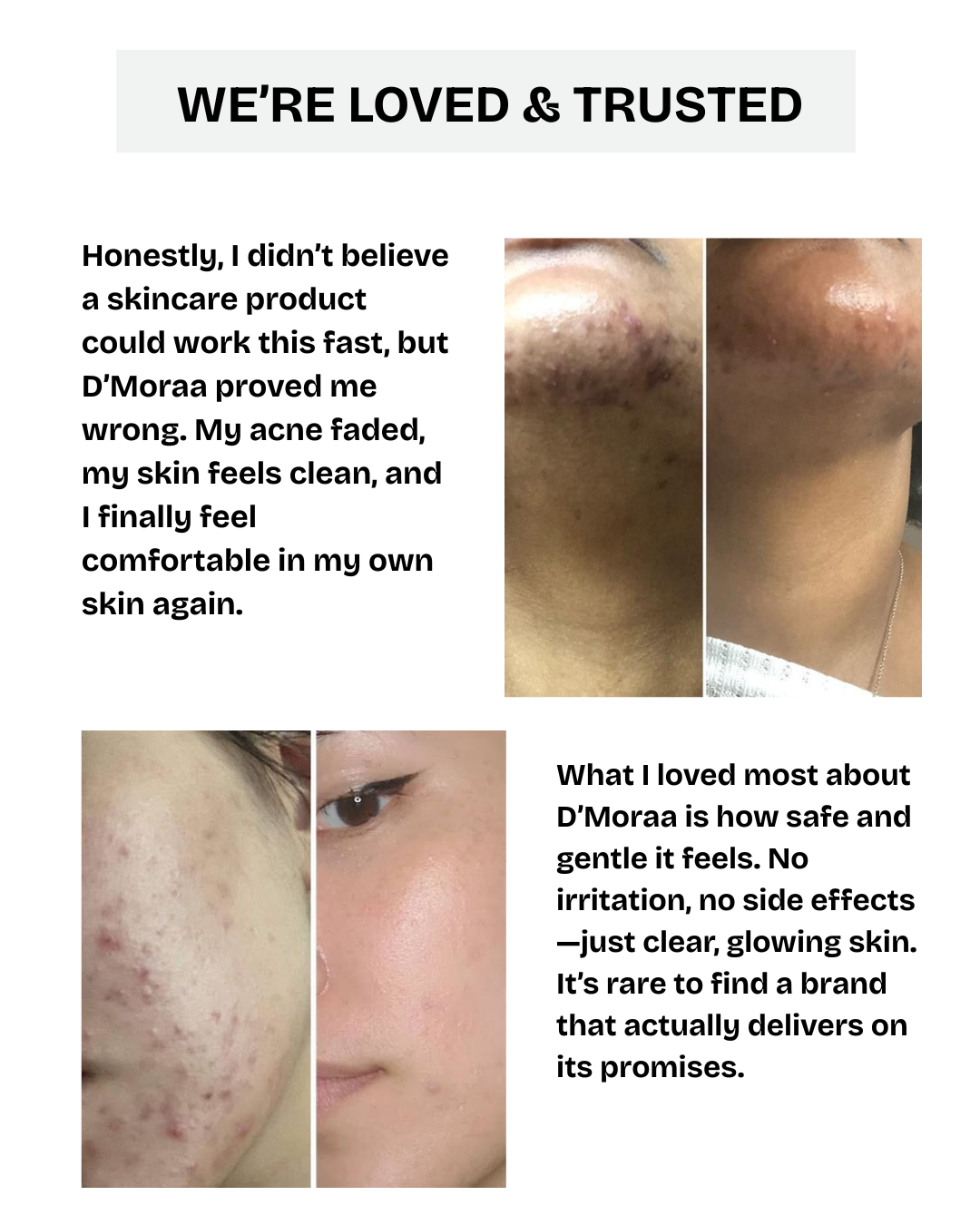 Acne & Scar Treatment Serum | All Skin Type - 30ml