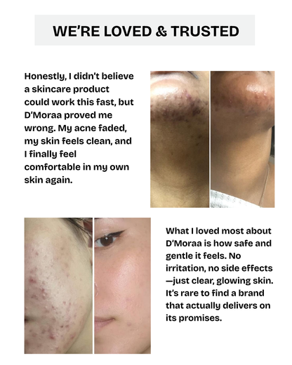 Acne & Scar Treatment Serum | All Skin Type - 30ml